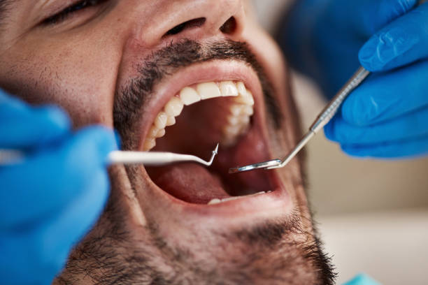 Best Urgent Care for Lost Fillings or Crowns in El Dorado Hills, CA