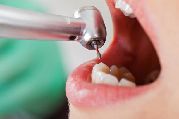 Best Emergency Treatment for Dental Infections or Abscesses in El Dorado Hills, CA
